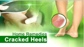 Home Remedies for Cracked Heels